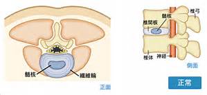 画像①　髄核が中央にある正常な状態