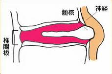 画像②　髄核が後方にズレている状態